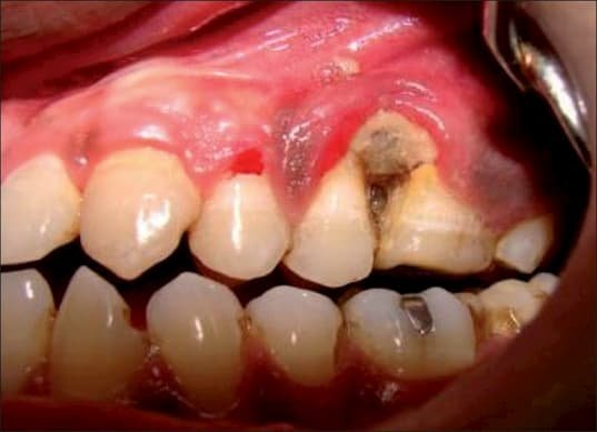 Nekrotik Periodontal Hastalığı taşıyan  bir ağız